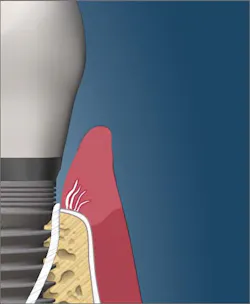 Floss fully severing the attachment from the gingiva to the implant Floss fully severing the attachment from the gingiva to the implant