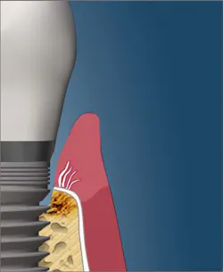 Bacterial toxins destroying bone Bacterial toxins destroying bone