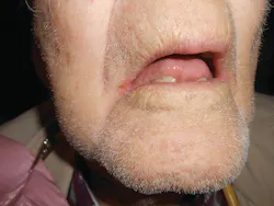 Figure 1: An 80-year-old man with chronic angular cheilitis. Note the loss of dimension due to tooth loss and dermal dexterity. Figure 1: An 80-year-old man with chronic angular cheilitis. Note the loss of dimension due to tooth loss and dermal dexterity.