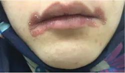 Figure 2: This patient had chronic angular cheilitis that continued to progress. It was determined that the patient had iron-deficiency anemia. Figure 2: This patient had chronic angular cheilitis that continued to progress. It was determined that the patient had iron-deficiency anemia.