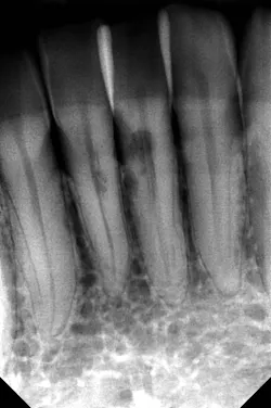 Figure 3: An example of external cervical resorption. Note the ability to trace the canal through the radiolucent defect. Figure 3: An example of external cervical resorption. Note the ability to trace the canal through the radiolucent defect.