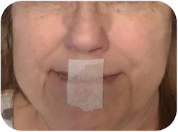 Figure 2: To practice mouth taping for sleep, fold the end of the tape over 2 to 3 mm (top). Then either tape from philtrum to chin (middle), or commisure to commisure (bottom). One-inch paper tape shown. Figure 2: To practice mouth taping for sleep, fold the end of the tape over 2 to 3 mm (top). Then either tape from philtrum to chin (middle), or commisure to commisure (bottom). One-inch paper tape shown.