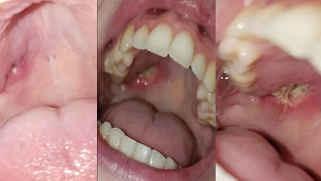Figure 1: Intraoral photo (left) prior to seeing a general dentist. Pt. experienced three small holes in soft palate. General dentist referred to oral surgeon. The three small holes expanded into one large hole (center) before oral surgeon could be seen. Oral surgeon diagnosed necrotic tissue and took biopsy that confirmed Wegener's Granulomatosis diagnosis. After the biopsy, stitches were placed (right).
