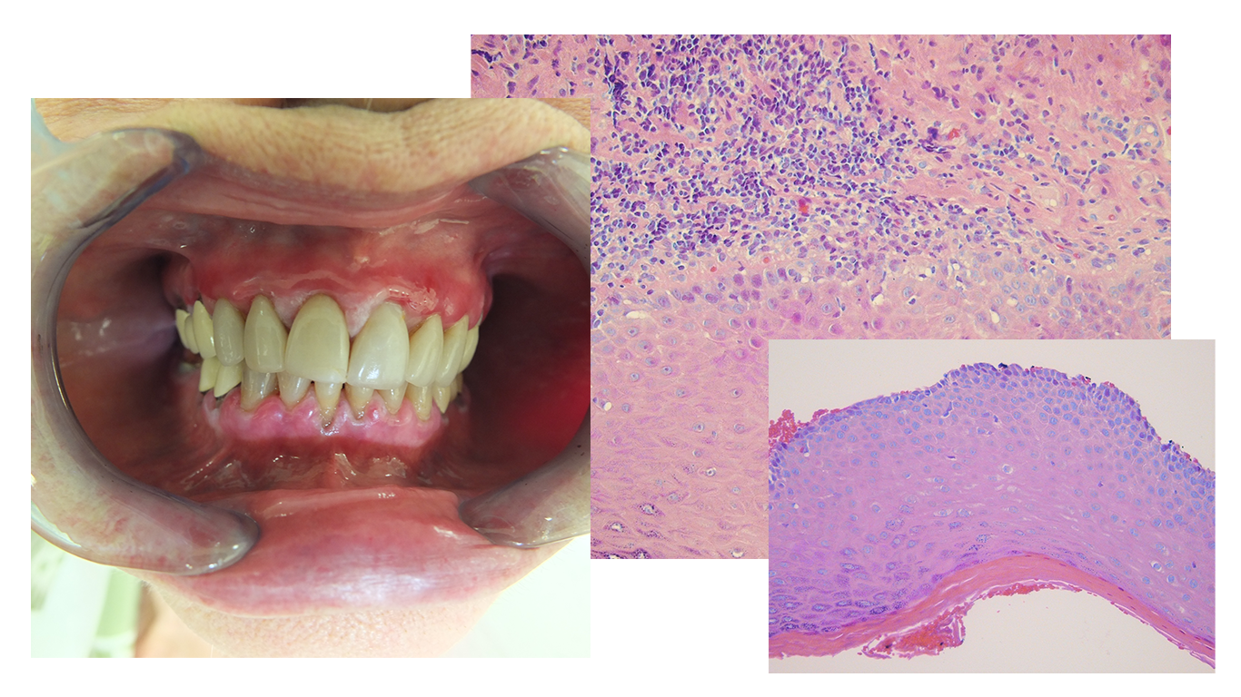 Lichen Planus Pemphigoides