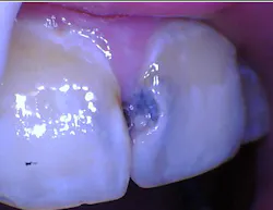 Figure 1a: Oral dysbiosis: dental caries Figure 1a: Oral dysbiosis: dental caries