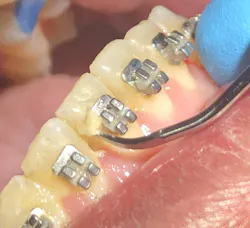 Figure 3: Mechanical removal of biofilm Figure 3: Mechanical removal of biofilm