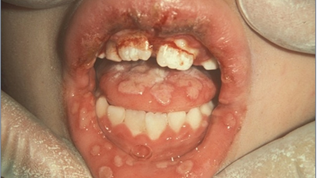 primary herpes simplex virus (HSV)