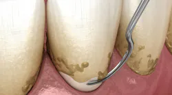 Chronic Inflammatory Periodontal Disease Chronic Inflammatory Periodontal Disease