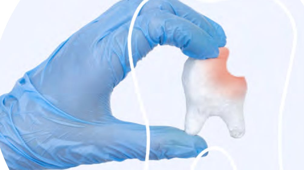 silverdiaminefluoride