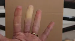 Hand with Raynaud's Hand with Raynaud's