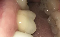 Figure 3: SDF was applied as a desensitizing agent along the gumline with slight recession. Figure 3: SDF was applied as a desensitizing agent along the gumline with slight recession.