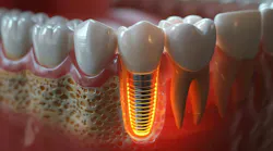 Dental implants and fluoride Dental implants and fluoride