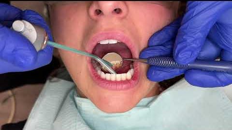 Tips for Working Around a Lingual Permanent Retainer