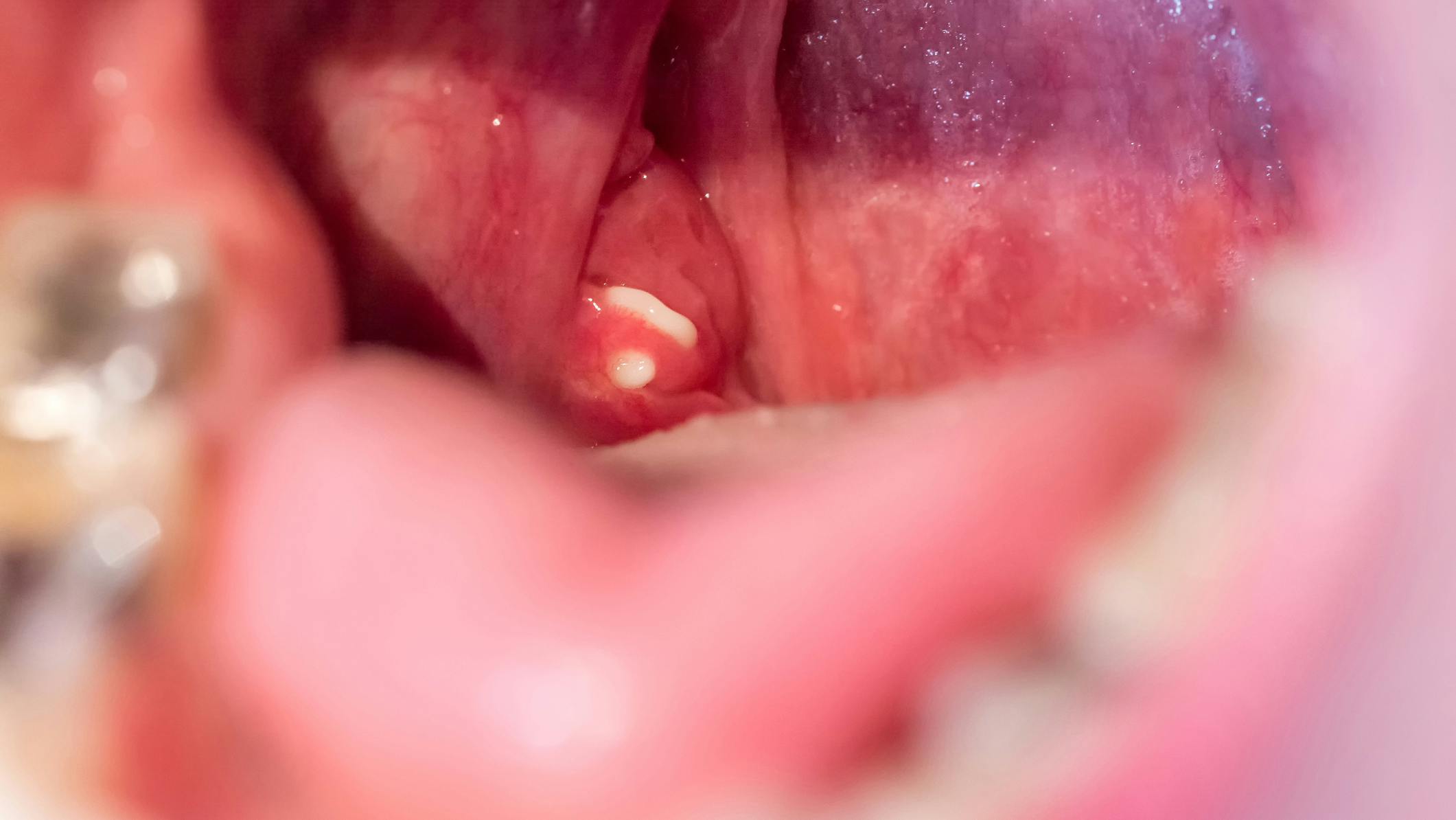 6760646f694f6d4c47513eb2 Tonsil Stones