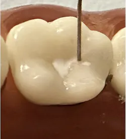 Figure 3: Voco’s sealant (Grandio Seal) being spread on occlusal surface without using an explorer tip Figure 3: Voco’s sealant (Grandio Seal) being spread on occlusal surface without using an explorer tip