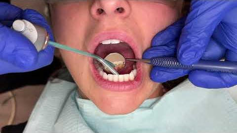 Tips for Working Around a Lingual Permanent Retainer