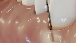 probing a dental gum probing a dental gum