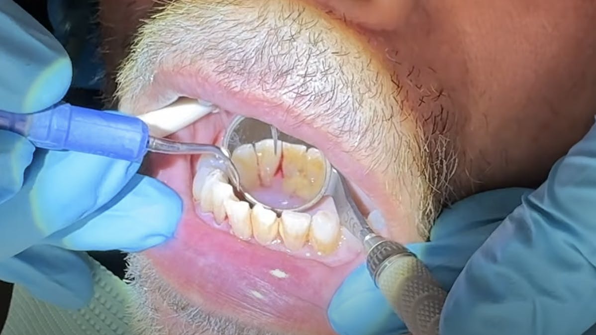 Here are tips for removing burnished calculus, which can be very sneaky.