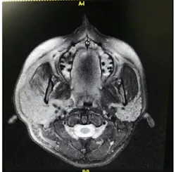 Figure 4b. Sialdenosis CBCT Figure 4b. Sialdenosis CBCT
