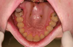 Figure 6: Discolored teeth, dental caries, palatal mucosal abrasion Figure 6: Discolored teeth, dental caries, palatal mucosal abrasion