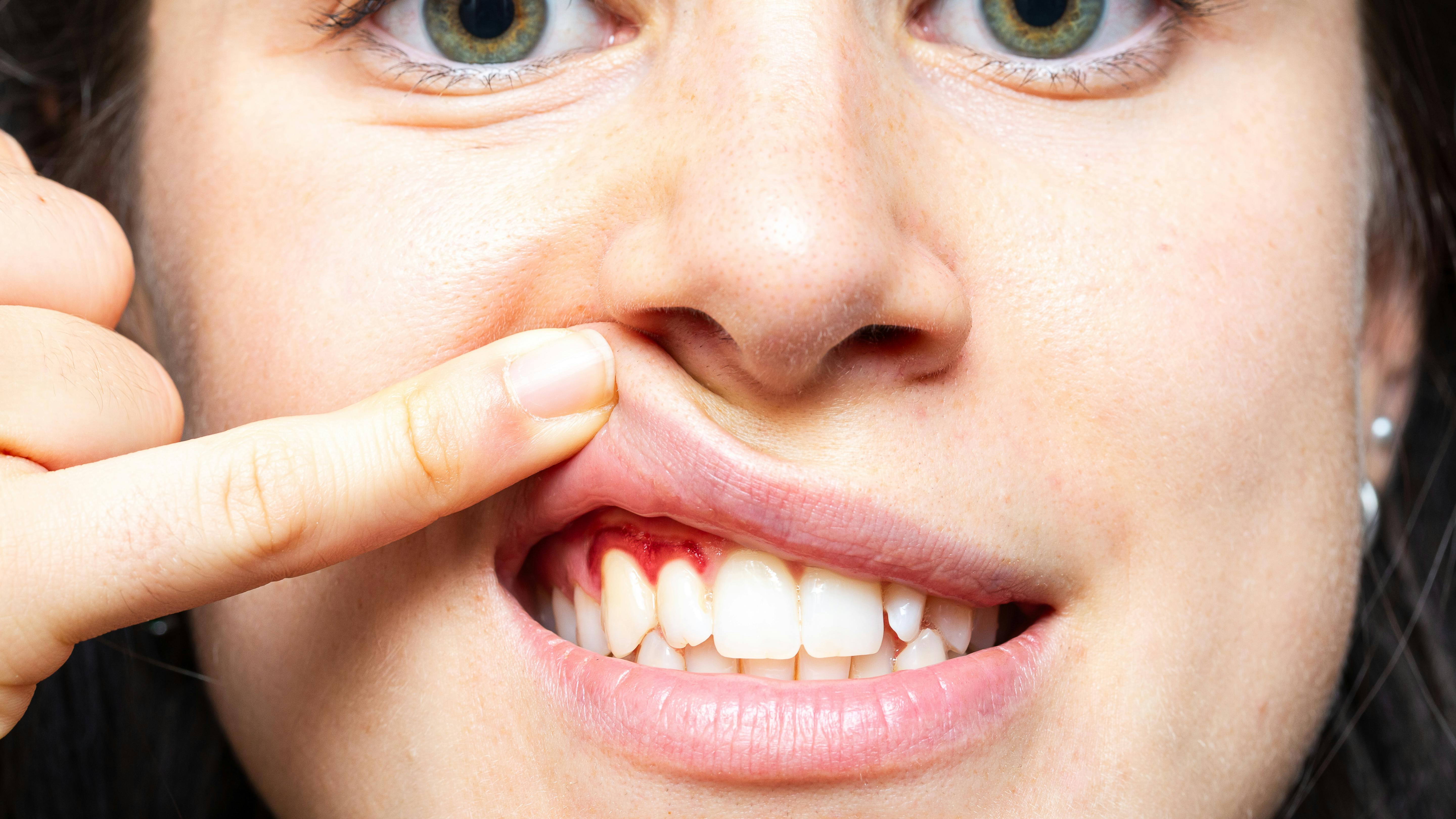 woman holding her lip up with one finger showing her bleeding gums