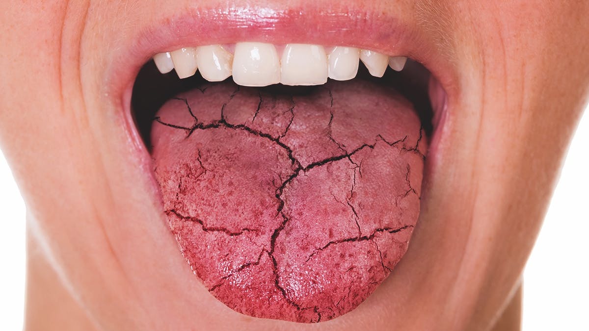 cracked tongue sticking out denoting dry mouth