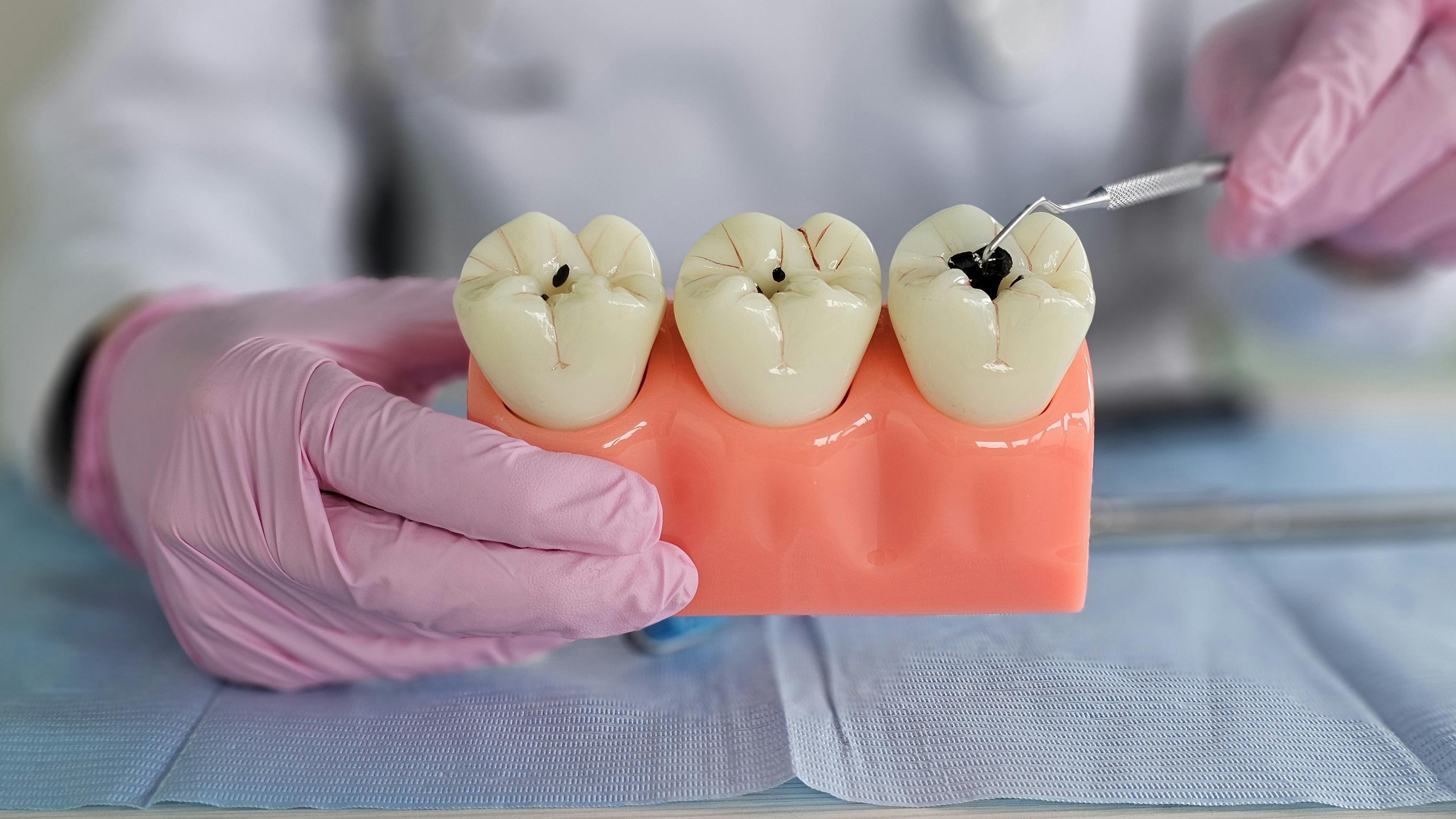 tooth model with dental caries