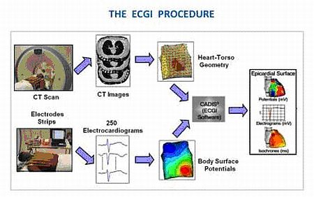 Electrocardiographic imaging (ECGI) can help locate the source of a dangerous cardiac arrhythmia called ventricular tachycardia (VT)