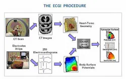 Electrocardiographic imaging (ECGI) can help locate the source of a dangerous cardiac arrhythmia called ventricular tachycardia (VT) Electrocardiographic imaging (ECGI) can help locate the source of a dangerous cardiac arrhythmia called ventricular tachycardia (VT)