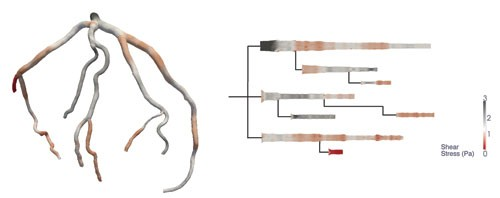A team at Harvard has developed a 2-D method of visualizing human arteries, called HemoVis, that may result in more accurate diagnoses of atherosclerosis and heart disease. Image courtesy of Michelle Borkin.