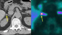 PET-CT scan test uses radioactive tracer to locate adenomas that can cause hypertension. Image credit: Morris Brown PET-CT scan test uses radioactive tracer to locate adenomas that can cause hypertension. Image credit: Morris Brown