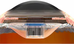 Eye telescope helps restore vision Eye telescope helps restore vision