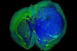 Content Dam Vsd Online Articles 2013 09 Brain Tumors Copy Content Dam Vsd Online Articles 2013 09 Brain Tumors Copy