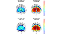 Figure 3: Examples of cortical sensitivity of low-density (a, c) and high-density (b, d) array NIR spectroscopy on a brain with severe atrophy due to Alzheimer’s disease (a, b) and a healthy brain (c, d). Figure 3: Examples of cortical sensitivity of low-density (a, c) and high-density (b, d) array NIR spectroscopy on a brain with severe atrophy due to Alzheimer’s disease (a, b) and a healthy brain (c, d).
