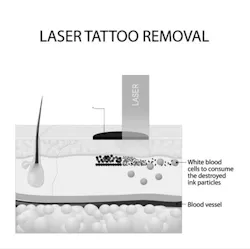 One application of laser optics for skin care is breaking up ink particles for tattoo removal. One application of laser optics for skin care is breaking up ink particles for tattoo removal.